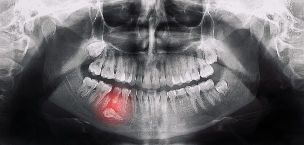 Dental panoramic x-ray showing an impacted wisdom tooth